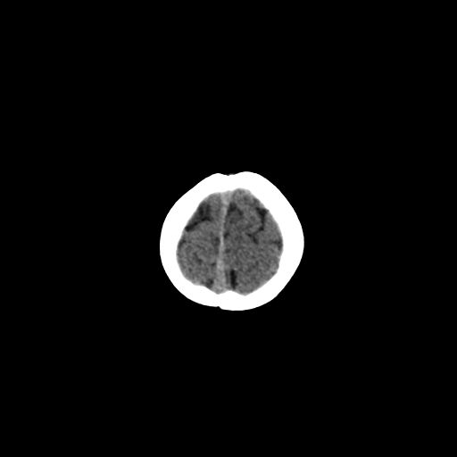 Acute phase of hemiconvulsion-hemiplegia epilepsy syndrome (Radiopaedia 29309-29744 Axial non-contrast 5).jpg