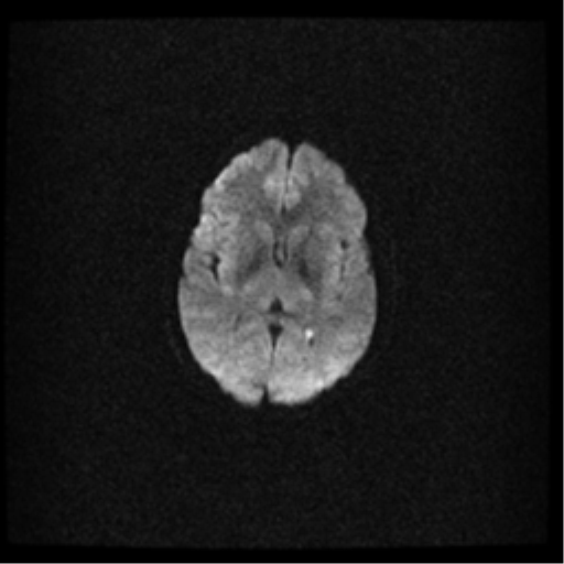 File:Acute pontine infarct from vertebral artery dissection (Radiopaedia 34111-35370 Axial DWI 12).png