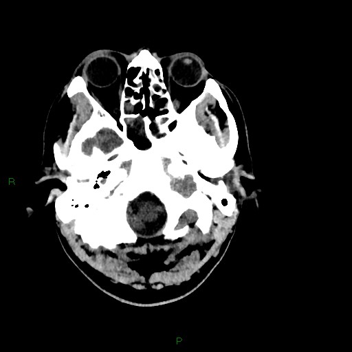 Acute posterior cerebral artery territory infarct (Radiopaedia 79329-92393 Axial non-contrast 14).jpg
