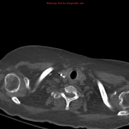 Acute pulmonary embolism (Radiopaedia 13286-13289 Axial C+ CTPA 2).jpg