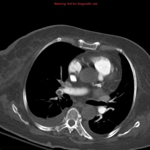 Acute pulmonary embolism (Radiopaedia 13286-13289 Axial C+ CTPA 34).jpg