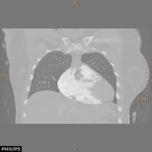 File:Acute reversible pulmonary hypertension and right heart failure from cocaine toxicity (Radiopaedia 49394-54517 Coronal C+ CTPA 10).jpg