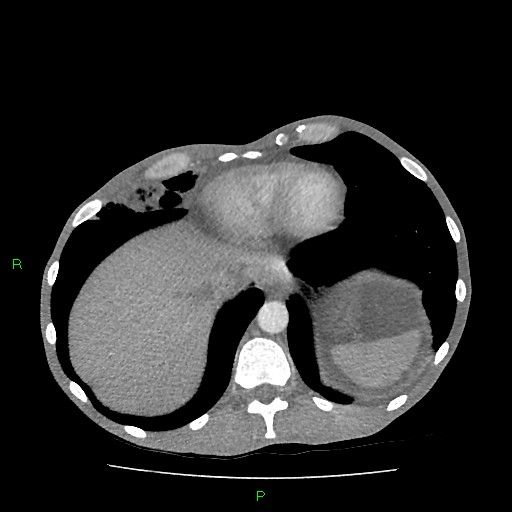 File:Acute right lung abscess (Radiopaedia 34806-36258 Axial C+ arterial phase 156).jpg