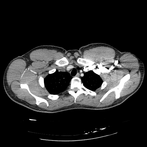 Acute segmental pulmonary emboli and pulmonary infarction (Radiopaedia 62264-70444 Axial C+ CTPA 21).jpg