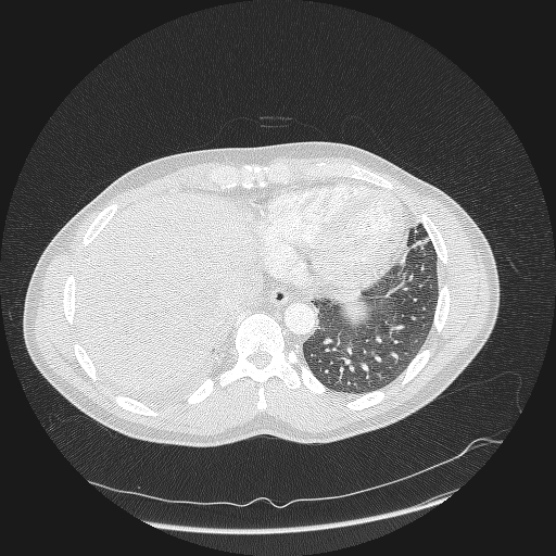 Acute segmental pulmonary emboli and pulmonary infarction (Radiopaedia 62264-70444 Axial lung window 158).jpg