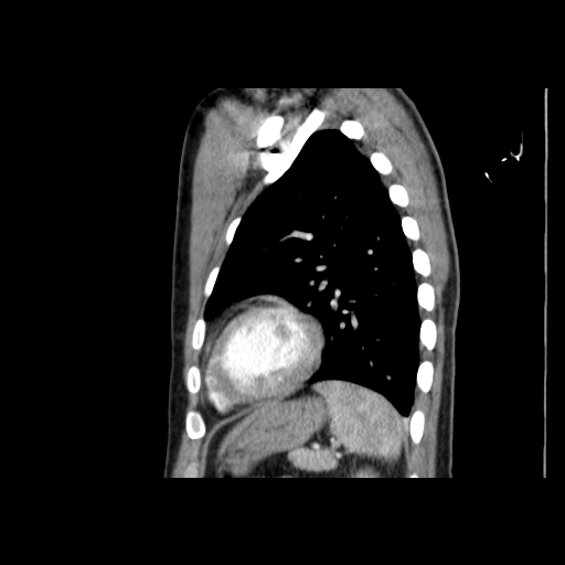 File:Acute segmental pulmonary emboli and pulmonary infarction (Radiopaedia 62264-70444 Sagittal C+ CTPA 49).jpg