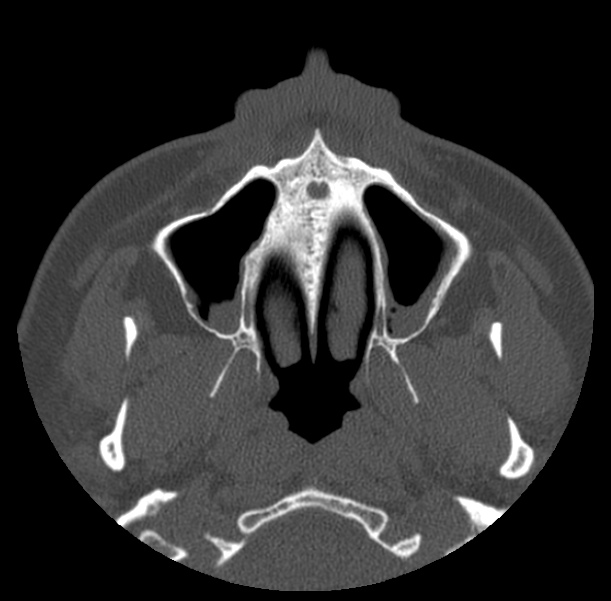 Acute sinusitis (Radiopaedia 23161-23215 Axial bone window 13).jpg