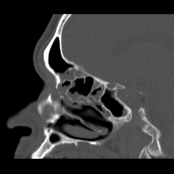 Acute sinusitis (Radiopaedia 23161-23215 Sagittal bone window 27).jpg