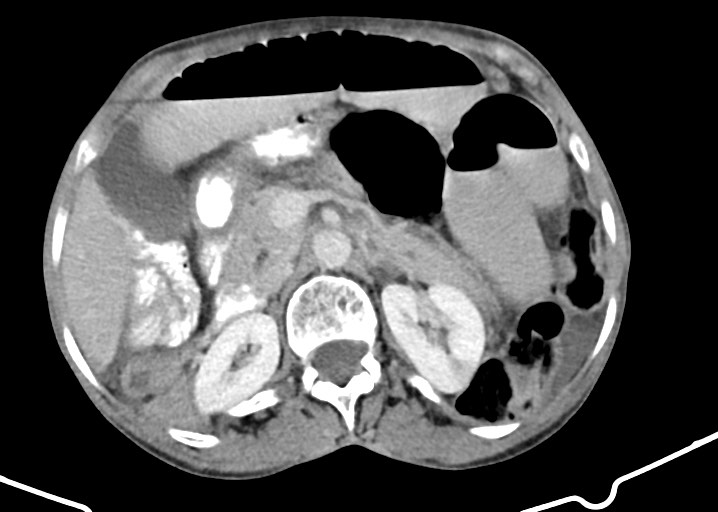 Acute small bowel (ileal) volvulus (Radiopaedia 71740-82139 Axial C+ portal venous phase 79).jpg