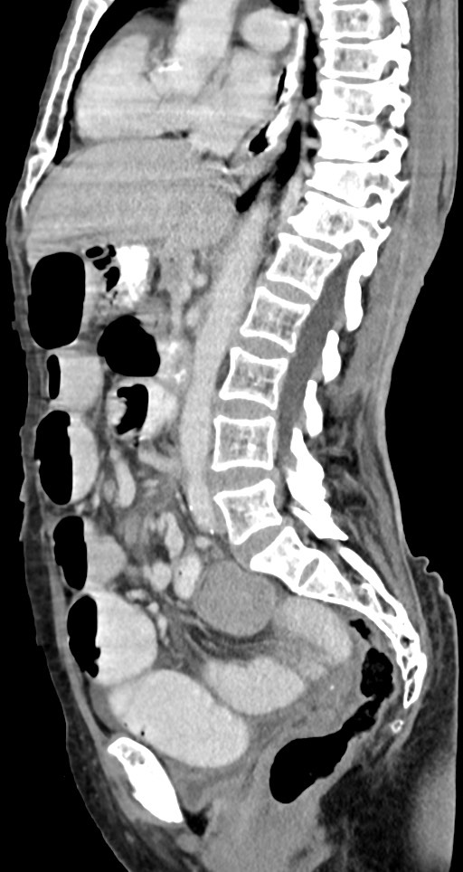 Acute small bowel (ileal) volvulus (Radiopaedia 71740-82139 Sagittal C+ portal venous phase 90).jpg