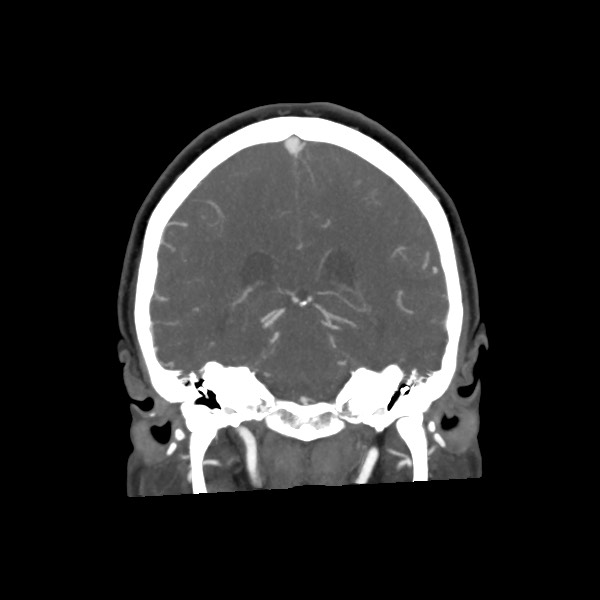 File:Acute subarachnoid hemorrhage and accessory anterior cerebral artery (Radiopaedia 69231-79009 Coronal C+ arterial phase 50).jpg