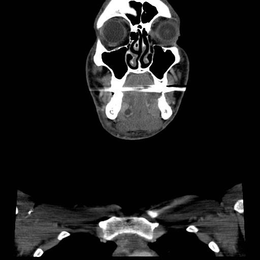 File:Acute submandibular sialadenitis secondary to ductal stone (Radiopaedia 27999-28267 D 15).jpg