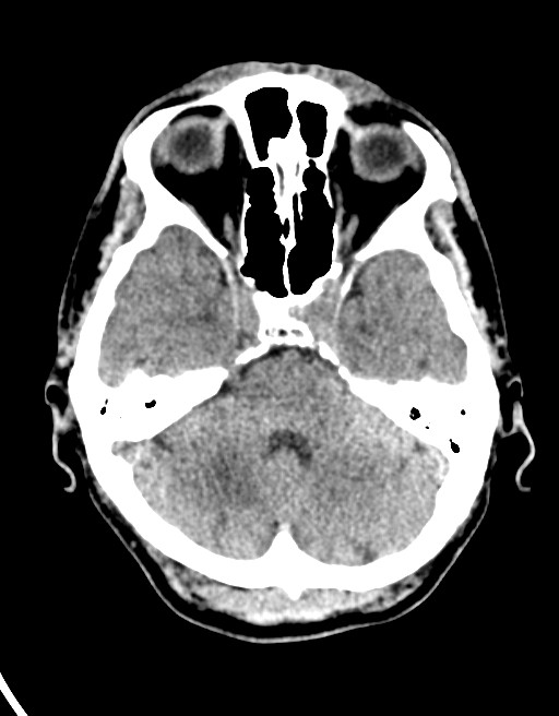Acute superior cerebellar artery territory infarct (Radiopaedia 84104-99359 Axial non-contrast 49).jpg