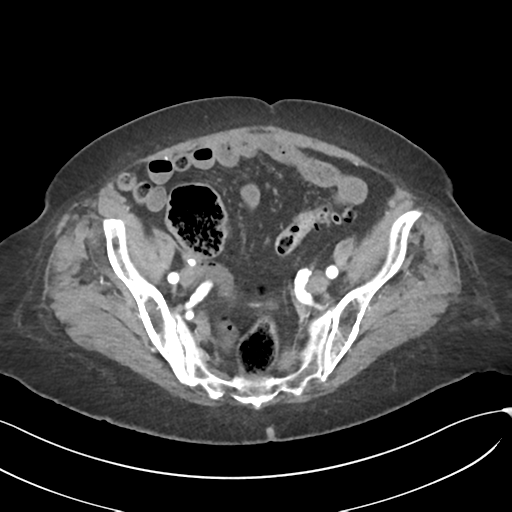 File:Acute superior mesenteric artery occlusion (Radiopaedia 43926-47418 Axial C+ portal venous phase 53).png