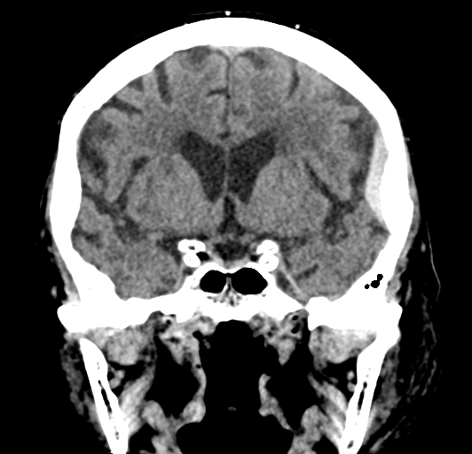 File:Acute traumatic subdural hematoma (Radiopaedia 82921-97257 Coronal non-contrast 41).jpg