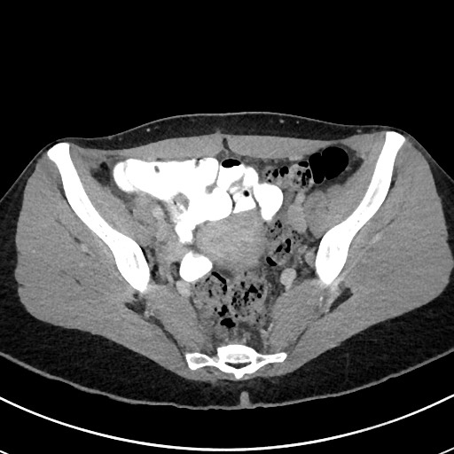 File:Acute uncomplicated appendicitis (Radiopaedia 61374-69304 Axial C+ portal venous phase 103).jpg