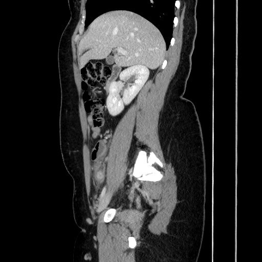 Acute uncomplicated appendicitis (Radiopaedia 73704-84499 Sagittal C+ portal venous phase 86).jpg