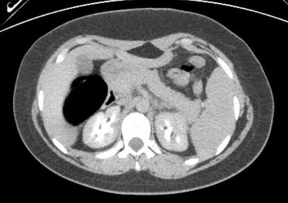 Acute unilateral nonhemorrhagic adrenal infarction (Radiopaedia 67560-76957 Axial renal excretory phase 41).jpg