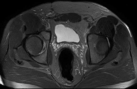 File:Adductor longus tear with retraction (Radiopaedia 56424-63103 Axial T2 fat sat 11).jpg