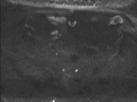 Adenocarcioma of rectum- T1 lesion (Radiopaedia 36921-38546 Axial DWI 57).png