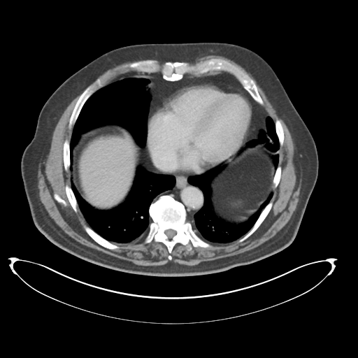 Adenocarcioma of rectum- T1 lesion (Radiopaedia 36921-38547 Axial C+ portal venous phase 9).png