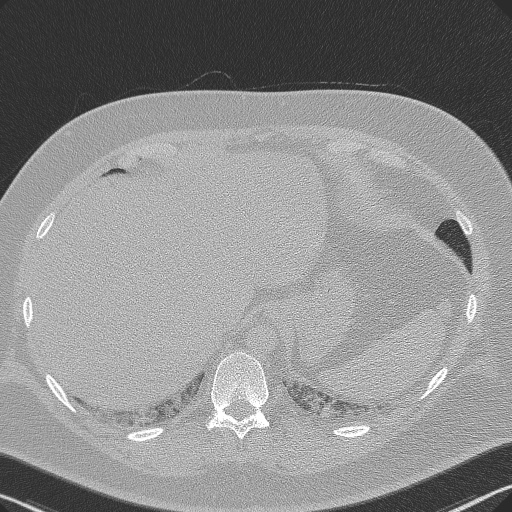 Adenoid cystic carcinoma of the trachea (Radiopaedia 49042-54137 Axial lung window 302).jpg