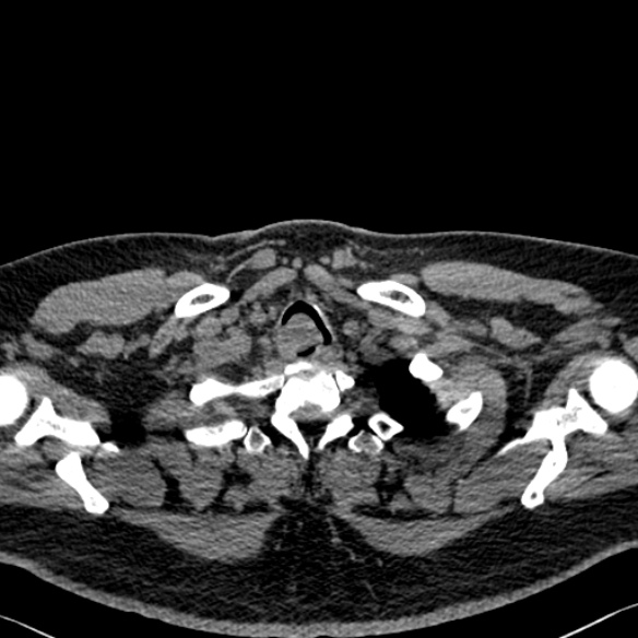 Adenoid cystic carcinoma of the trachea (Radiopaedia 49042-54137 Axial non-contrast 21).jpg