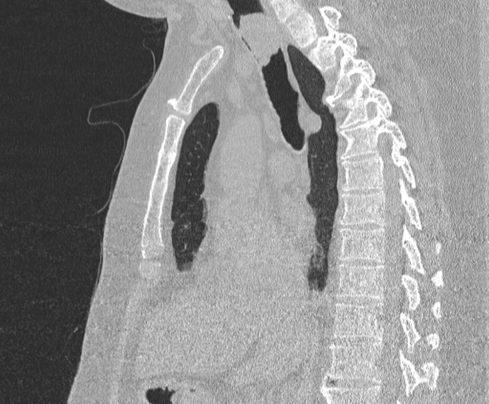 Adenoid cystic carcinoma of the trachea (Radiopaedia 49042-54137 Sagittal lung window 225).jpg