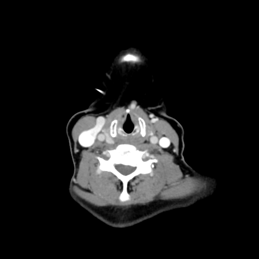 File:Adenoid cystic tumor of palate (Radiopaedia 46980-51518 Axial C+ delayed 50).png