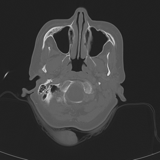 Adenoid cystic tumor of palate (Radiopaedia 46980-51518 Axial bone window 22).png