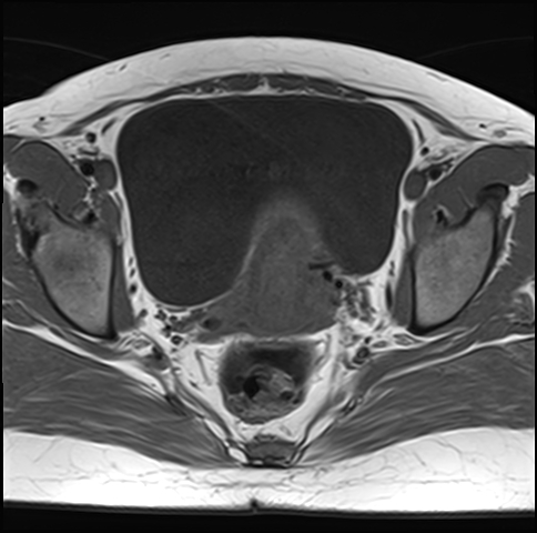 File:Adenomyosis - ovarian endometriomas (Radiopaedia 67031-76350 Axial T1 18).jpg