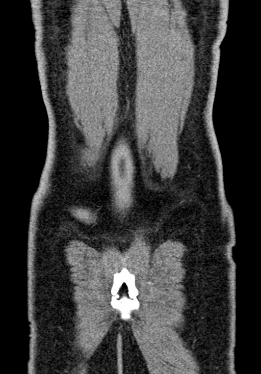 Adhesional small bowel obstruction (Radiopaedia 58900-66131 Coronal C+ portal venous phase 227).jpg