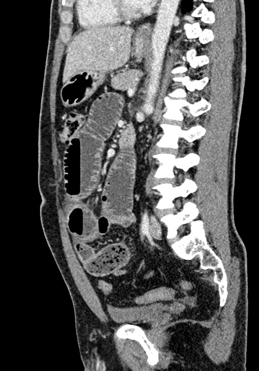 Adhesional small bowel obstruction (Radiopaedia 58900-66131 Sagittal C+ portal venous phase 143).jpg