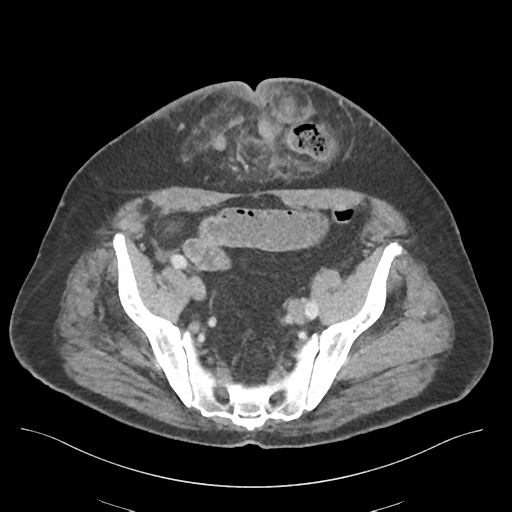 Adhesions within abdominal wall hernia (Radiopaedia 58283-65394 Axial C+ portal venous phase 67).png