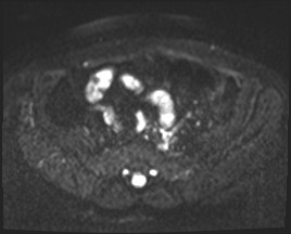 File:Adnexal multilocular cyst (O-RADS US 3- O-RADS MRI 3) (Radiopaedia 87426-103754 Axial DWI 4).jpg