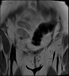 File:Adnexal multilocular cyst (O-RADS US 3- O-RADS MRI 3) (Radiopaedia 87426-103754 Coronal 5).jpg