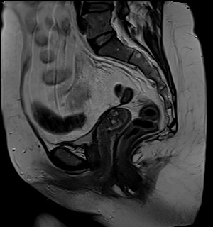 File:Adnexal multilocular cyst (O-RADS US 3- O-RADS MRI 3) (Radiopaedia 87426-103754 Sagittal T2 13).jpg