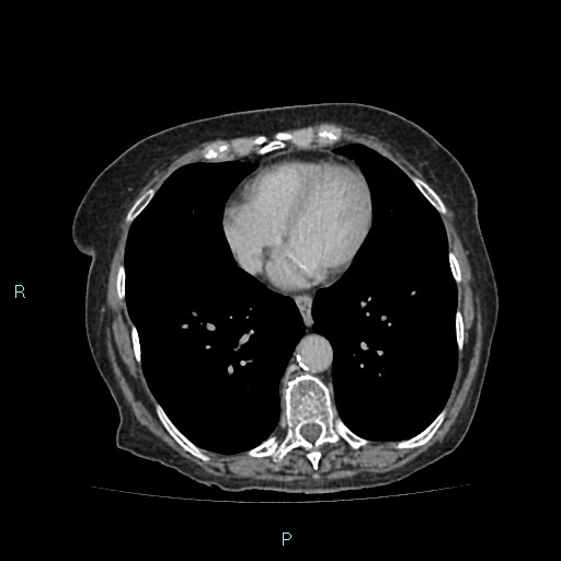 File:Adrenal collision tumor (ACT) (Radiopaedia 48462-53379 Axial C+ delayed 1).jpg
