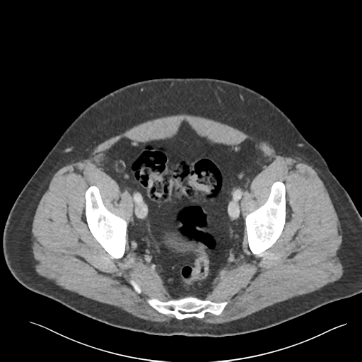 Adrenal cyst (Radiopaedia 45625-49777 Axial C+ portal venous phase 87).png