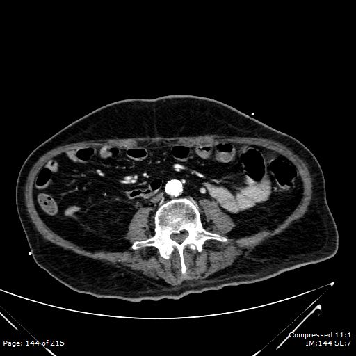 Adrenal metastasis (Radiopaedia 78425-91079 Axial C+ arterial phase 74).jpg