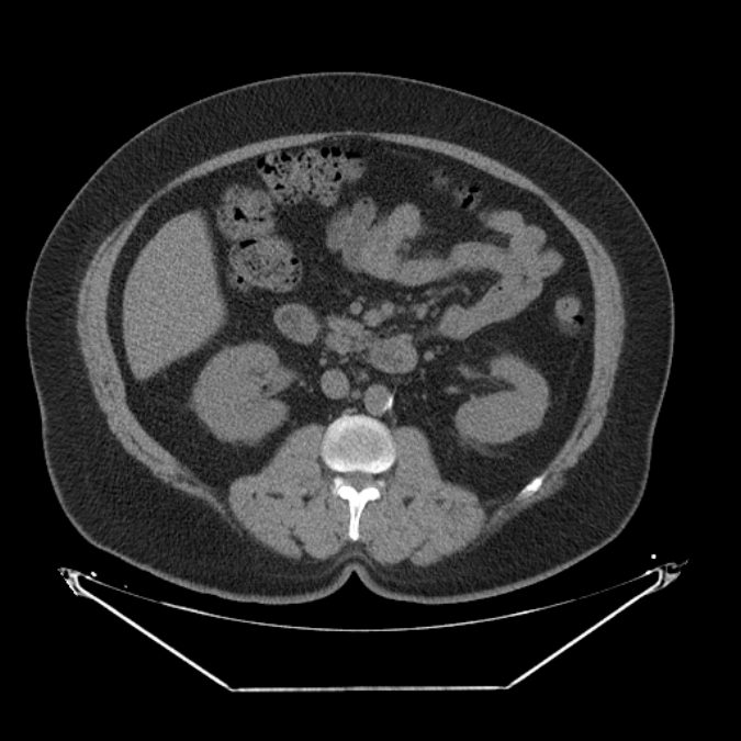 Adrenal myelolipoma (Radiopaedia 26278-26407 Axial non-contrast 30).jpg