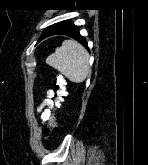 Adrenal myelolipoma (Radiopaedia 84319-99617 Sagittal renal cortical phase 87).jpg