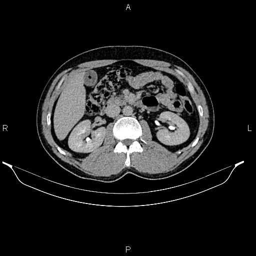 Adrenal myelolipoma (Radiopaedia 87794-104246 Axial renal excretory phase 41).jpg