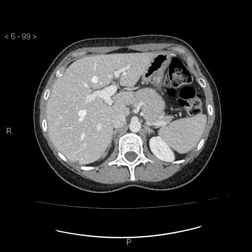 Adult transient intestinal intussusception (Radiopaedia 34853-36310 Axial C+ portal venous phase 1).jpg