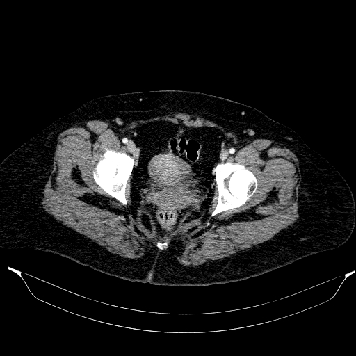 Afferent loop syndrome - secondary to incarcerated trocar site hernia (Radiopaedia 82959-97305 Axial C+ portal venous phase 219).jpg