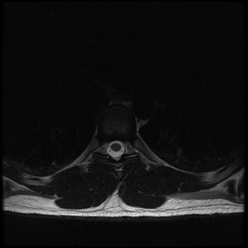 File:Aggressive vertebral hemangioma (Radiopaedia 39937-42404 Axial T2 18).png