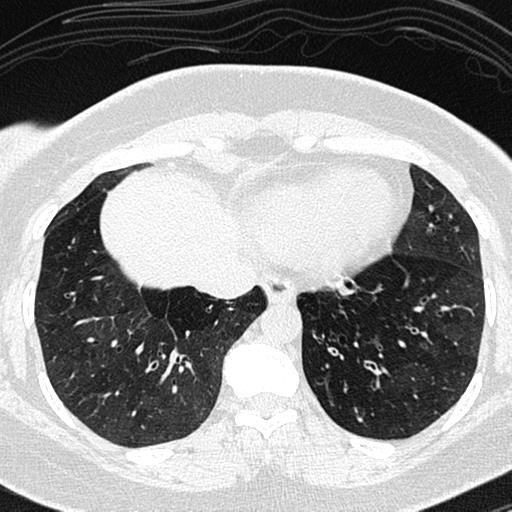 Air trapping in small airway disease (Radiopaedia 61685-69694 Axial lung window 139).jpg