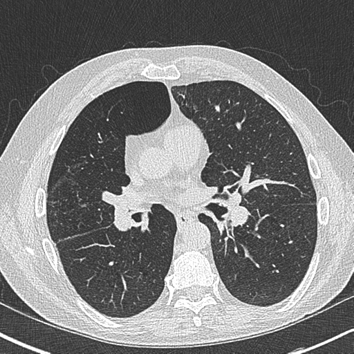 File:Allergic bronchopulmonary aspergillosis (Radiopaedia 44760-48571 Axial lung window 34).png