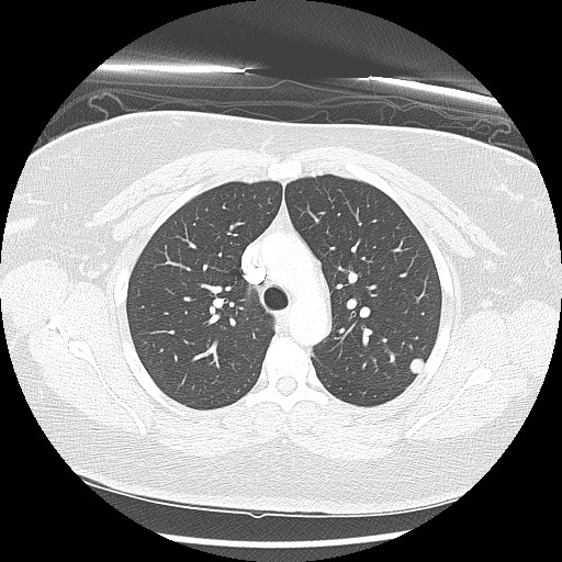 Alveolar soft part sarcoma - right leg (Radiopaedia 59432-67091 Axial lung window 36).jpg