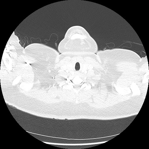 Alveolar soft part sarcoma - right leg (Radiopaedia 59432-67091 Axial lung window 5).jpg